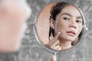 Inilah Cara Mengatasi Flek Hitam dan Hiperpigmentasi