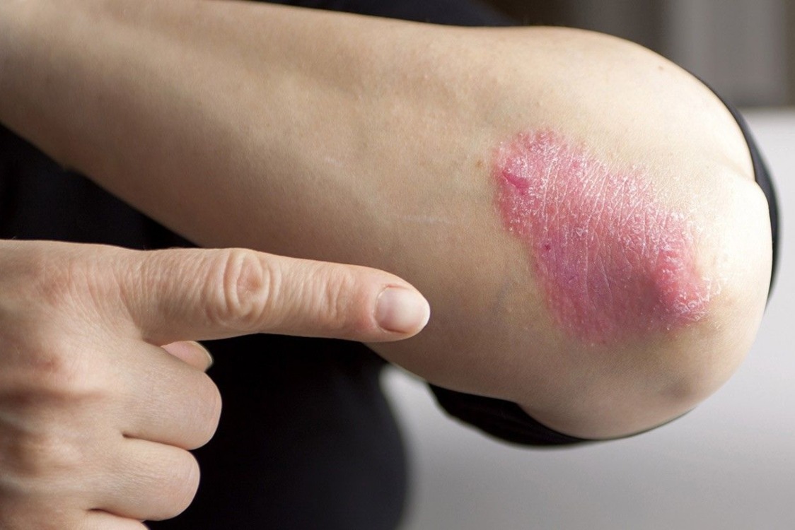 Inilah Obat Untuk Ruam Eksim dan Dermatitis Atopik Paling Ampuh