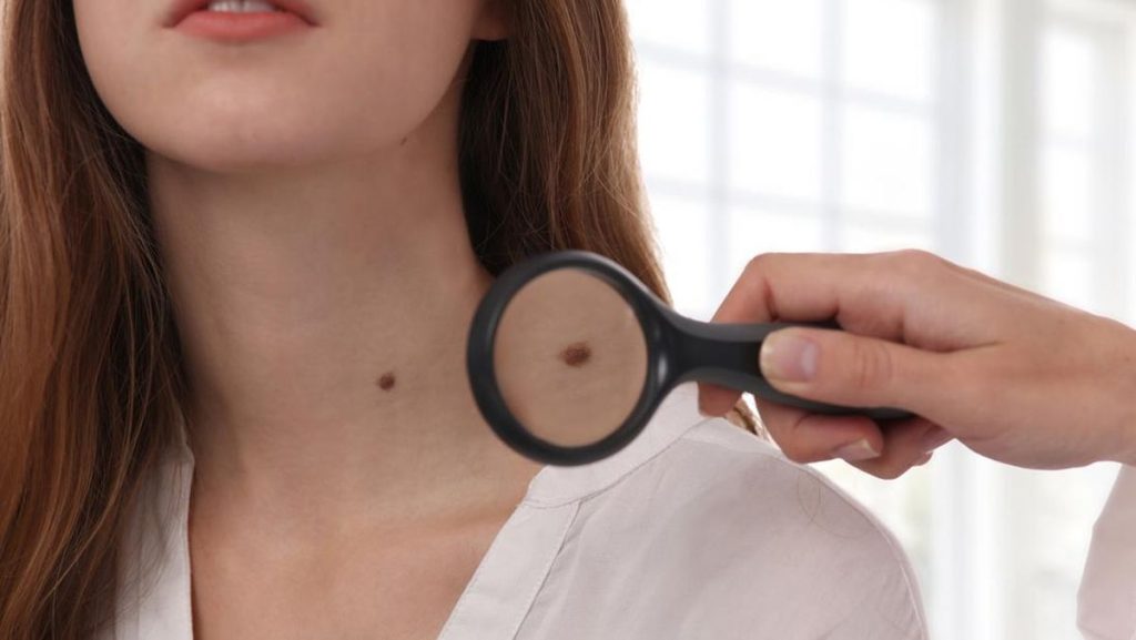 Kisah Perempuan yang Mendatangi Dokter Memeriksa Tahi Lalat
