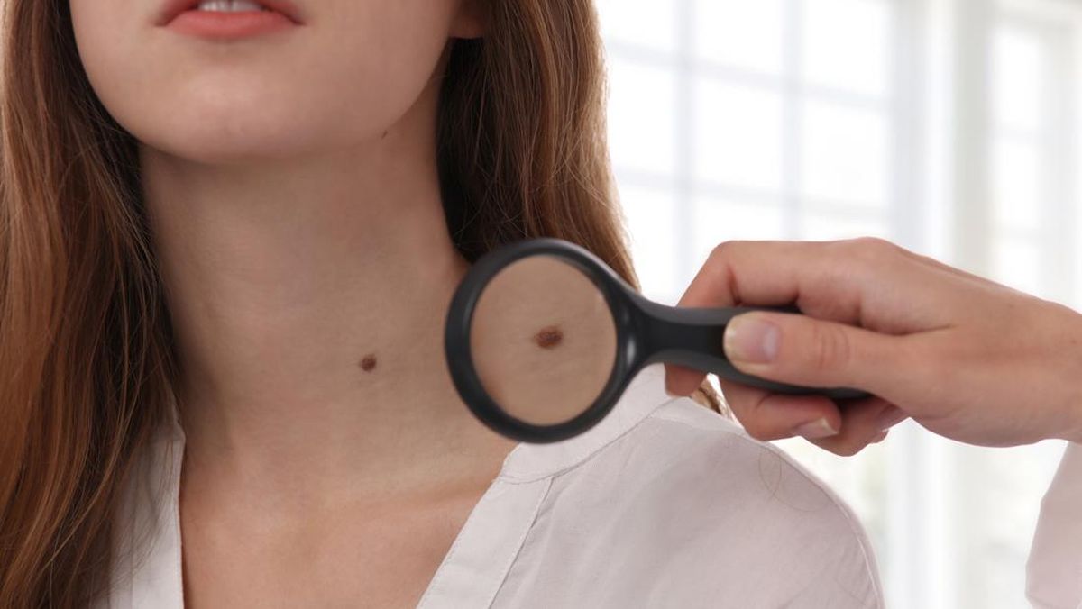 Kisah Perempuan yang Mendatangi Dokter Memeriksa Tahi Lalat