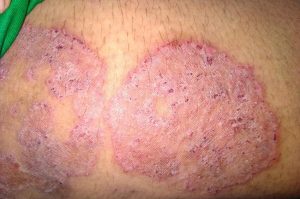 Mengenal Jenis-jenis Infeksi Jamur Kulit yang Tidak Terkenal