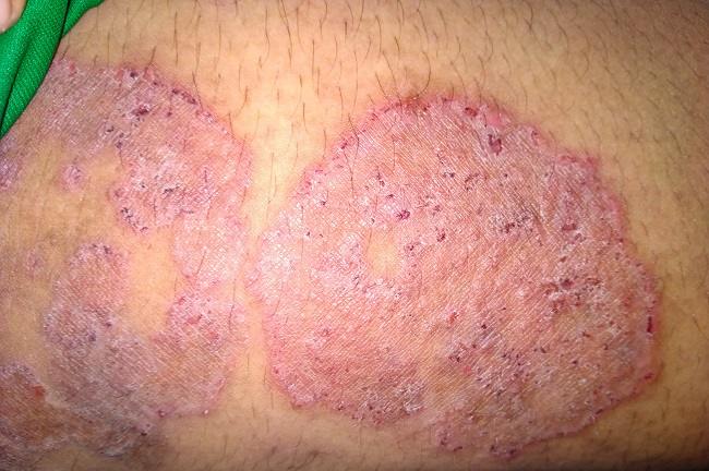 Mengenal Jenis-jenis Infeksi Jamur Kulit yang Tidak Terkenal