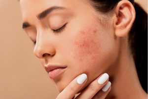 Mengenal Skin Barrier Sebagai Kunci Kesehatan Kulit Wajah