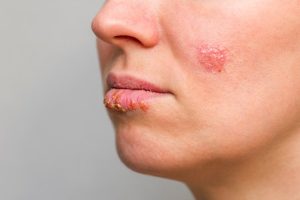 Apa Itu Herpes Simpleks Panduan Lengkap dan Gejalanya