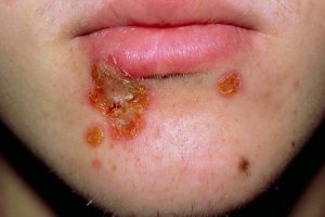 Cara Cepat dan Aman mengobati Impetigo di Rumah
