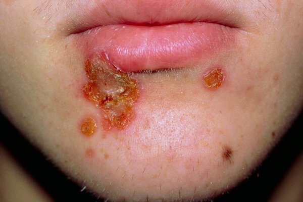 Cara Cepat dan Aman mengobati Impetigo di Rumah