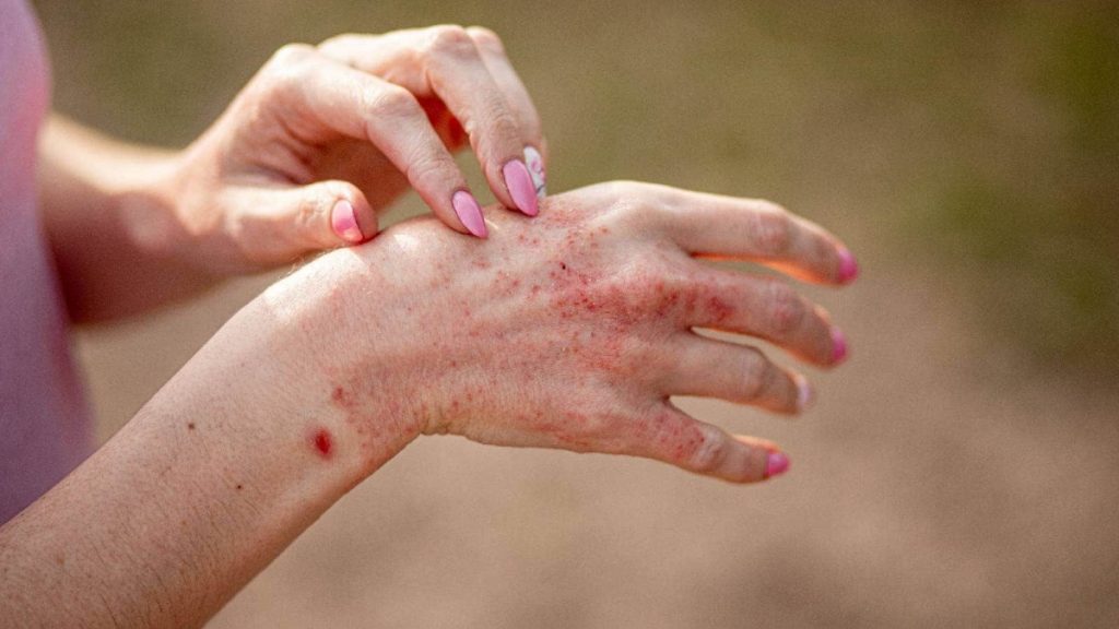 Dermatitis pada Tangan: Masalah Kulit Akibat Aktivitas Sehari-hari
