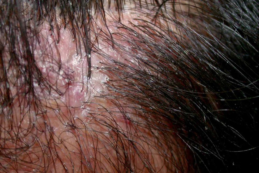 Folikulitis Kulit Kepala, Infeksi Folikel Rambut yang Menyebabkan Gatal