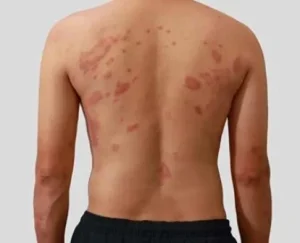 Penyebab Ruam Pityriasis Rosea dan Berapa Lama bisa Hilang?
