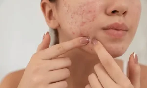 Jerawat di Masa Dewasa, Bagaimana Menghadapi Perubahan Hormonal