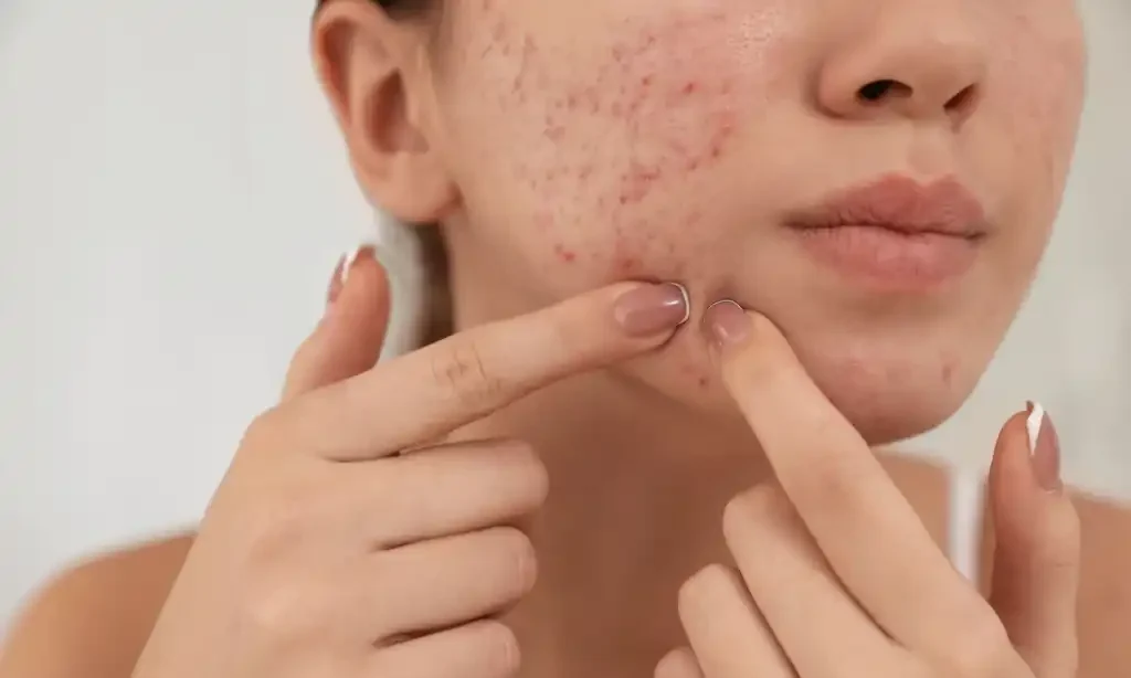 Jerawat di Masa Dewasa, Bagaimana Menghadapi Perubahan Hormonal