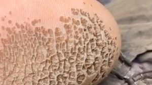 Kelembapan dan Bakteri: Yang Membuat Keratolisis Berlubang