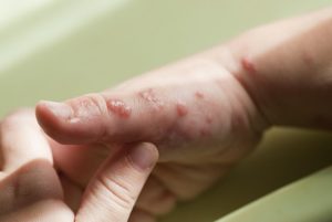 Jari Tangan Nyeri dan Melepuh, Waspada Bisa Jadi itu Herpetic Whitlow