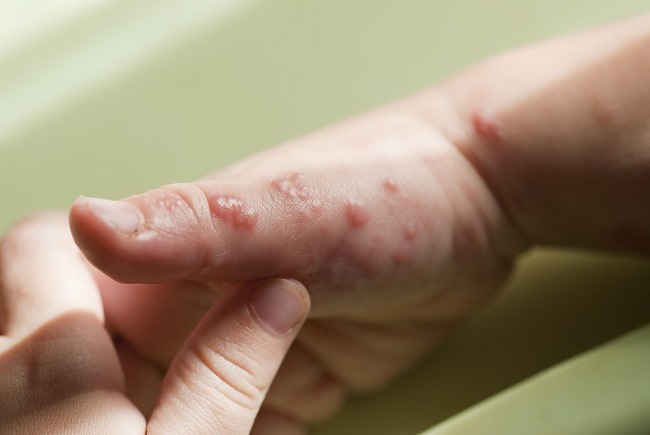 Jari Tangan Nyeri dan Melepuh, Waspada Bisa Jadi itu Herpetic Whitlow