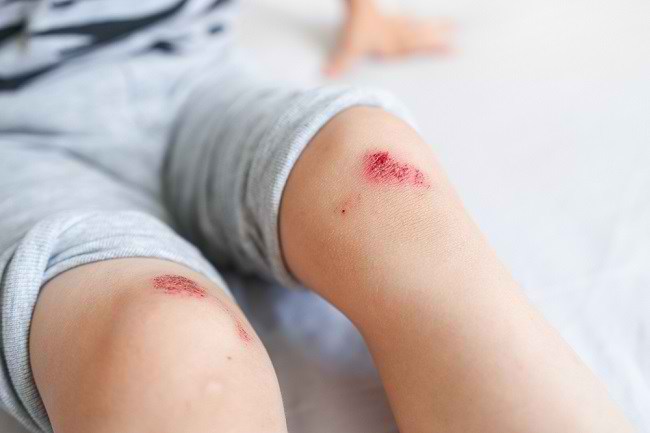 Luka Kecil Bisa jadi Masalah Besar, Inilah Fakta Tentang Bakteri
