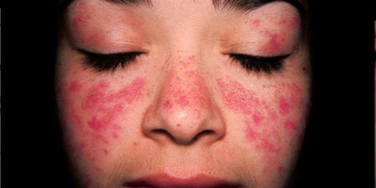 Lupus Eritematosus Diskoid, Penyebab Peradangan Kulit Berkepanjangan