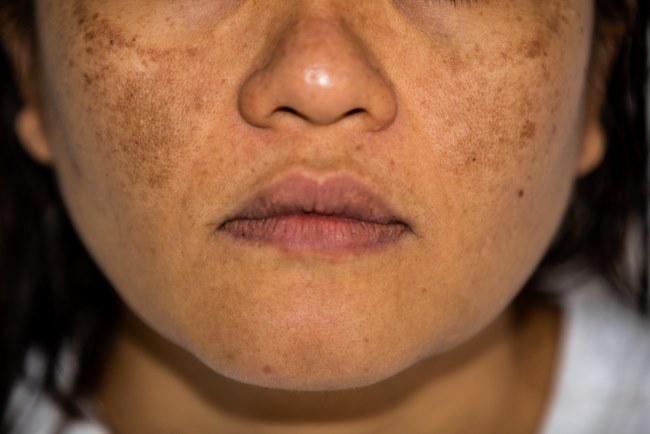 Melasma, Perubahan Warna Kulit yang Disebabkan Hormon dan Sinar Matahari