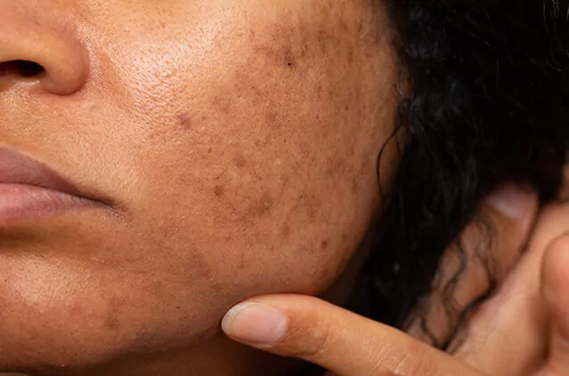 Memahami Lebih Jelas Melasma, Gangguan Pigmentasi Kulit yang Umum Terjadi
