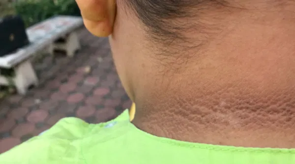 Acanthosis Nigricans Kulit Menghitam, Tanda Masalah Kesehatan