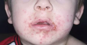 Impetigo: Infeksi Kulit yang Mudah Menular pada Anak dan Dewasa