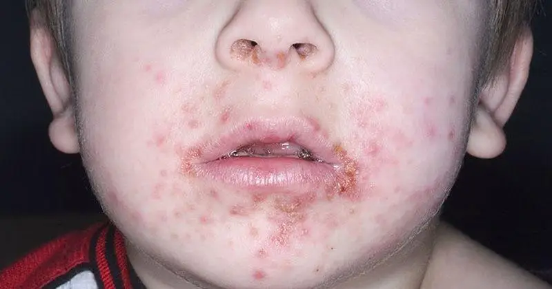 Impetigo: Infeksi Kulit yang Mudah Menular pada Anak dan Dewasa