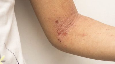 Mengenal Intertrigo dan Perubahan Kulit akibat Gesekan dan Kelembaban