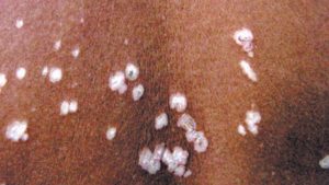 Mengenal Lichen Sclerosus, Kelainan Kulit yang Menyebabkan Gatal dan Nyeri