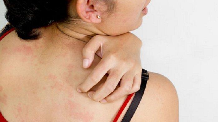 Kenali Miliaria: Biang Keringat yang Sering Muncul saat Cuaca Panas