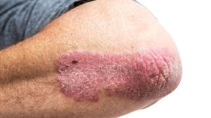 Mengenal Psoriasis, Penyakit Kulit Kronis yang Tidak Menular