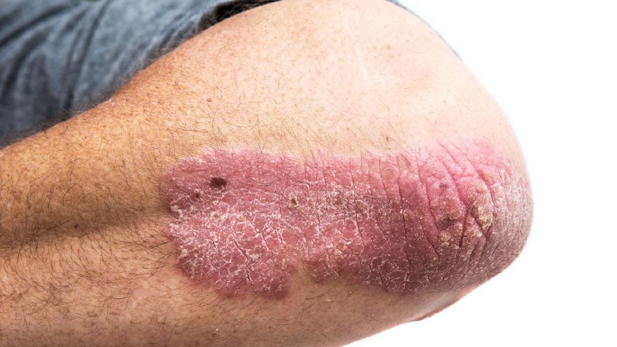 Mengenal Psoriasis, Penyakit Kulit Kronis yang Tidak Menular