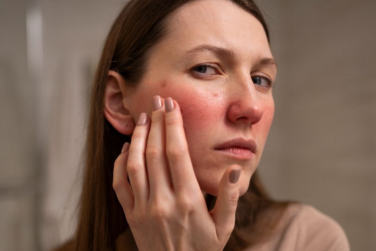 Mengenali Rosacea: Kondisi Kulit Gampang Wajah mudah Merah