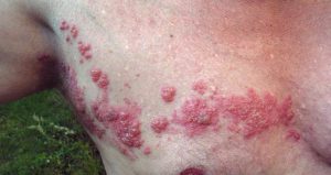 Mengenali Herpes Zoster: Infeksi saraf memicu ruam dan nyeri