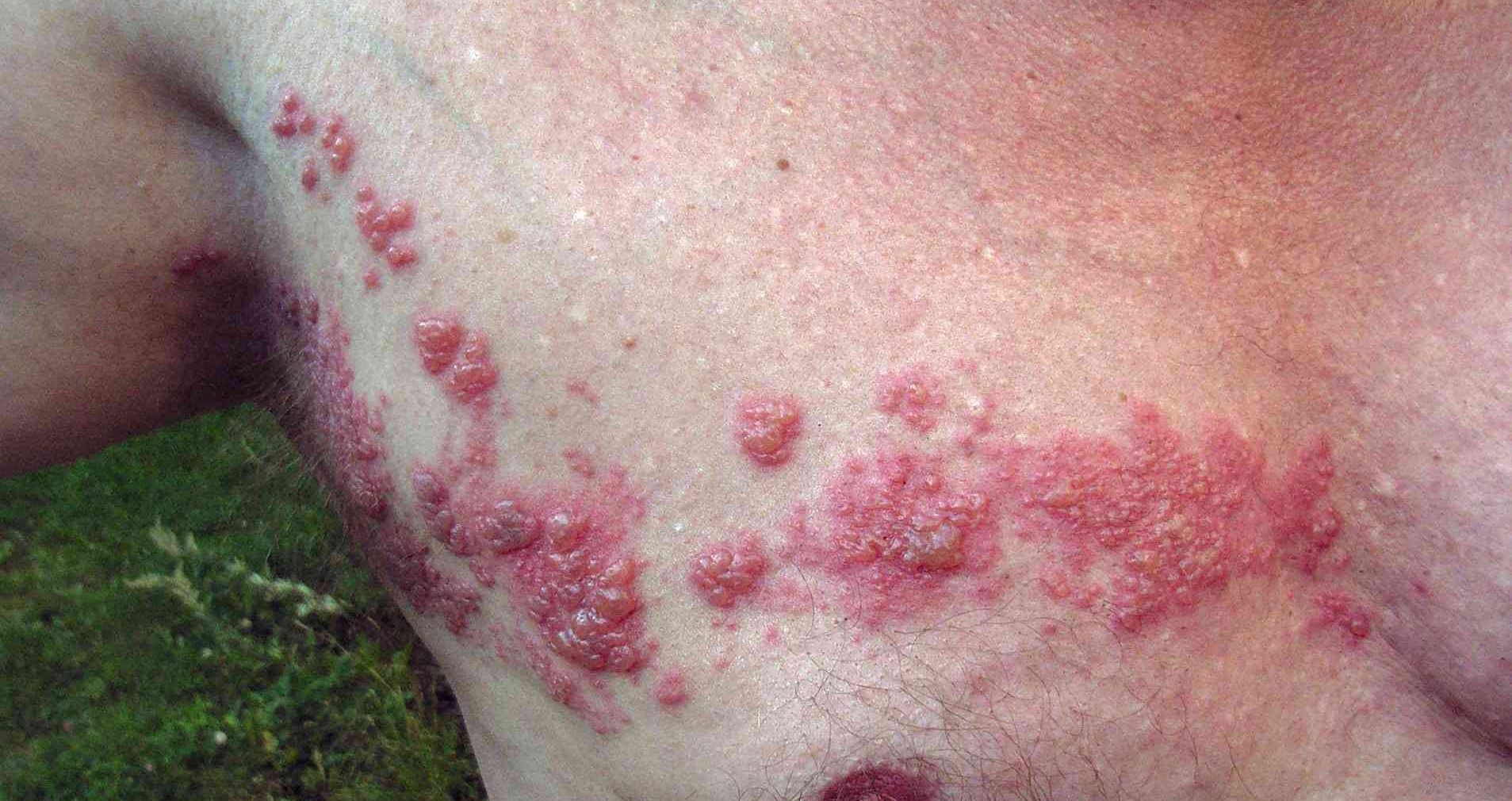 Mengenali Herpes Zoster: Infeksi saraf memicu ruam dan nyeri