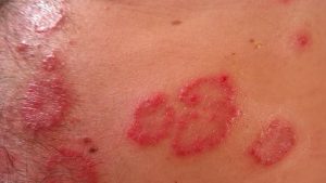 Kenali Tinea Korporis: Infeksi Jamur yang Sering Muncul di Kulit