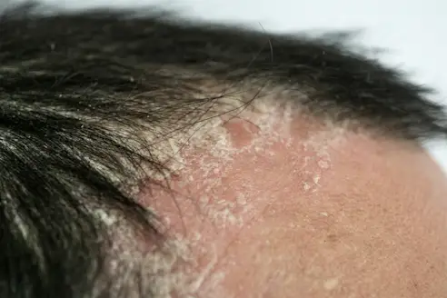 Psoriasis Kulit Kepala dan Rasa Tidak Nyaman yang Mengganggu Aktivitas