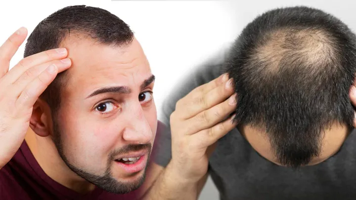 Memahami Alopecia Areata, Penyebab Kerontokan Rambut Mendadak di Area Tertentu