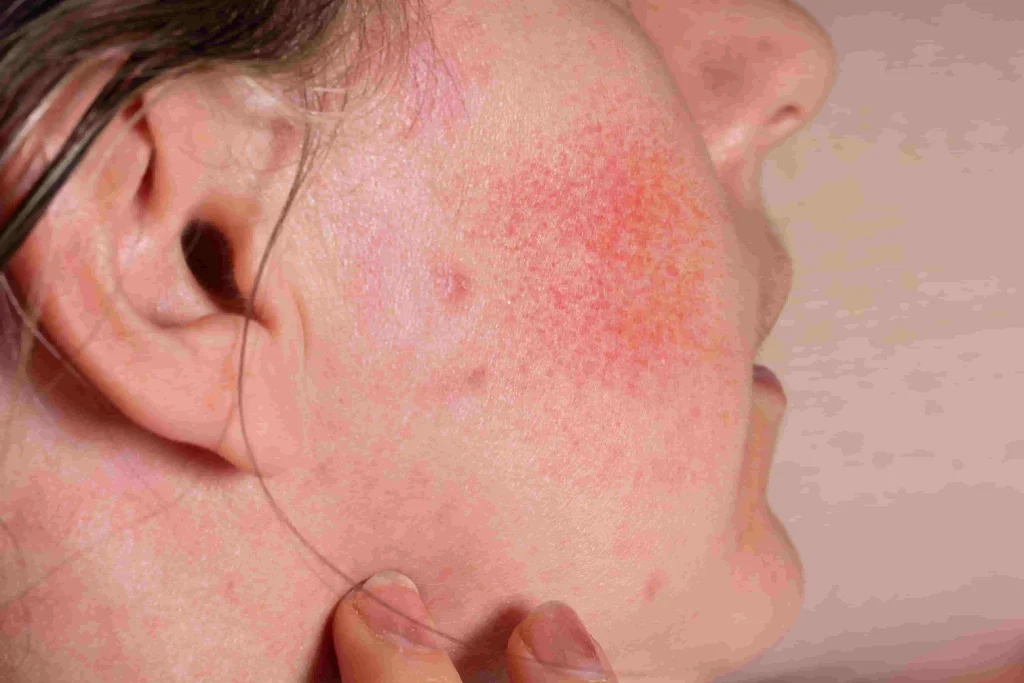 Rosacea Bukan Sekadar Kemerahan: Ini hal yang Perlu Diketahui