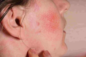 Rosacea Bukan Sekadar Kemerahan: Ini hal yang Perlu Diketahui