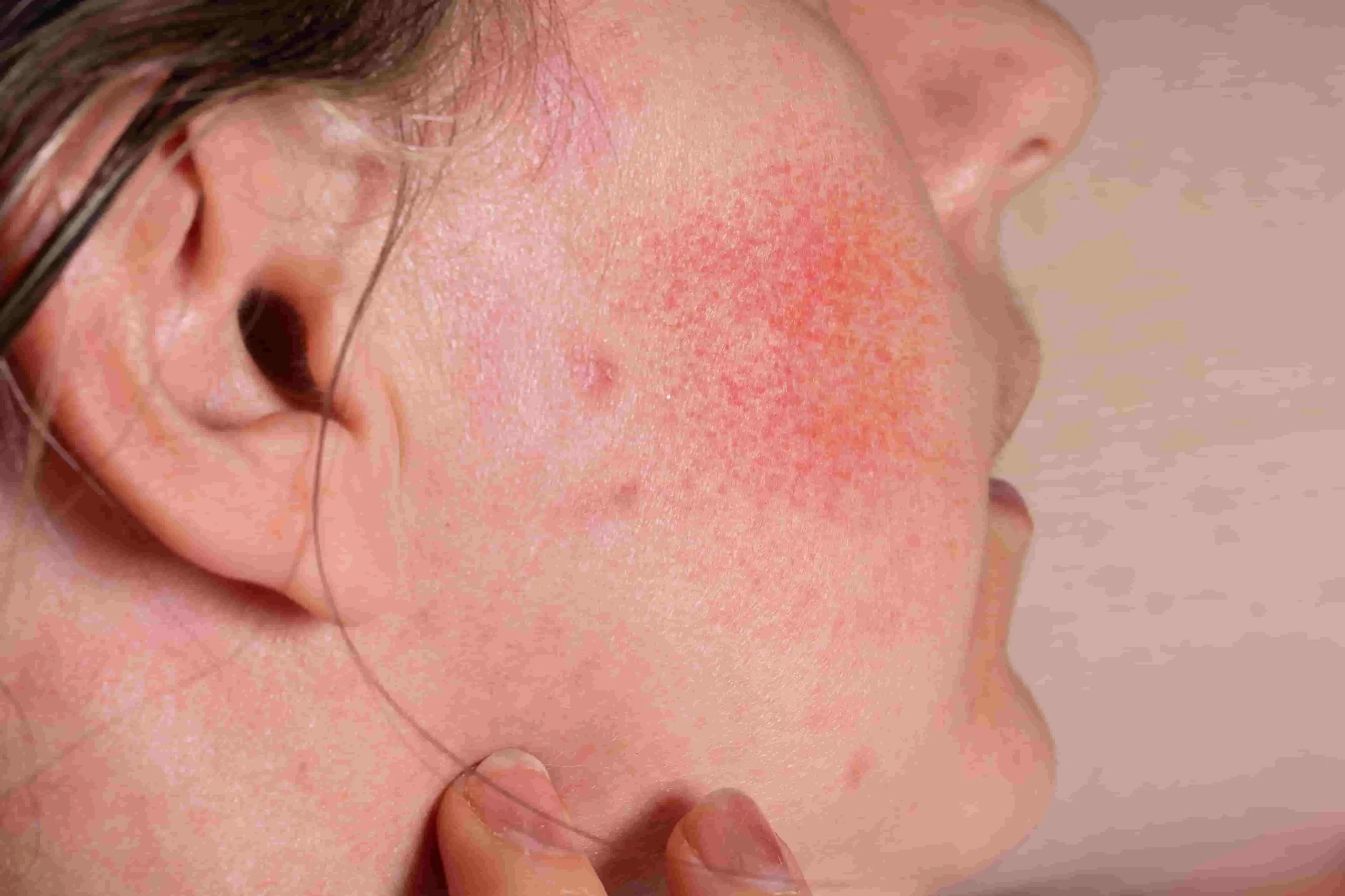 Rosacea Bukan Sekadar Kemerahan: Ini hal yang Perlu Diketahui