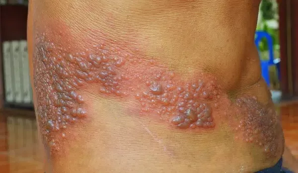Ruam Melepuh dan Terbakar: Tanda Herpes Zoster yang Diabaikan