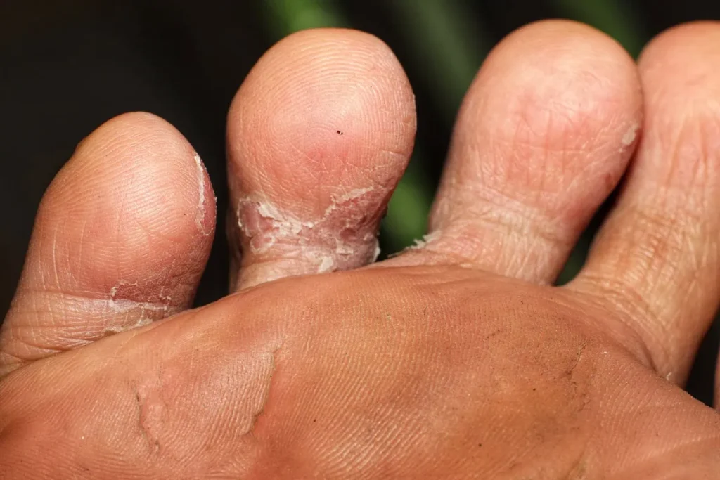 Penyakit Tinea Pedis, Infeksi Jamur yang Menyerang pada Kaki