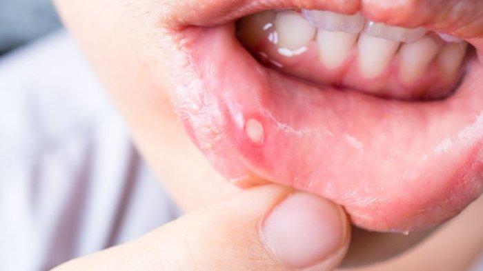 Ulkus Aftosa Sebagai Masalah kesehatan Mulut Yang Umum