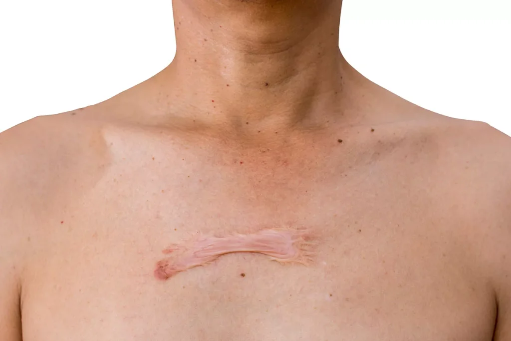 Bekas Luka Menebal dan Menonjol Apakah itu Keloid atau Luka Hipertrofik?