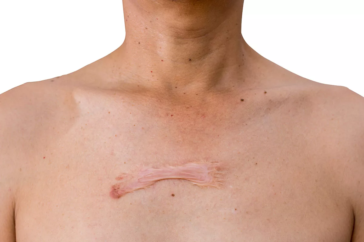 Bekas Luka Menebal dan Menonjol Apakah itu Keloid atau Luka Hipertrofik?