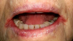 Bibir Sudut Meradang akibat Cheilitis Angularis, Ini Penjelasannya