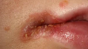 Cheilitis Angularis, Luka Pecah di Sudut Bibir yang Sering Mengganggu