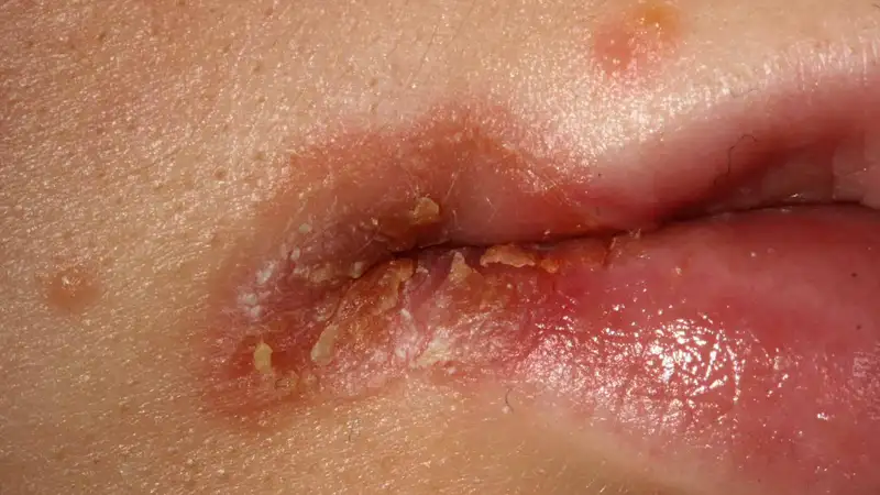 Cheilitis Angularis, Luka Pecah di Sudut Bibir yang Sering Mengganggu