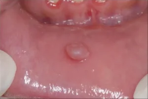 Inilah Penyebab Benjolan Kecil di Bibir dan Pipi Bagian Dalam