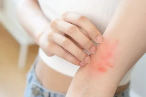 Dermatitis Aktinik Kronis, Peradangan Kulit Sensitif Cahaya