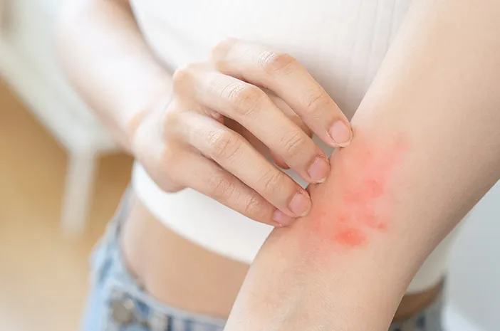 Dermatitis Aktinik Kronis, Peradangan Kulit Sensitif Cahaya